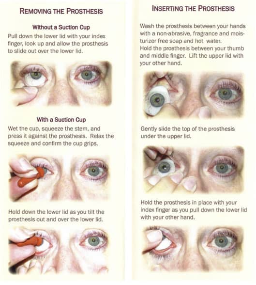 Frequently Asked Questions Artificial Eyes Australia